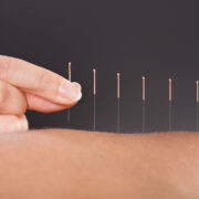 Hand-placing-acupuncture-needles-in-exposed-back
