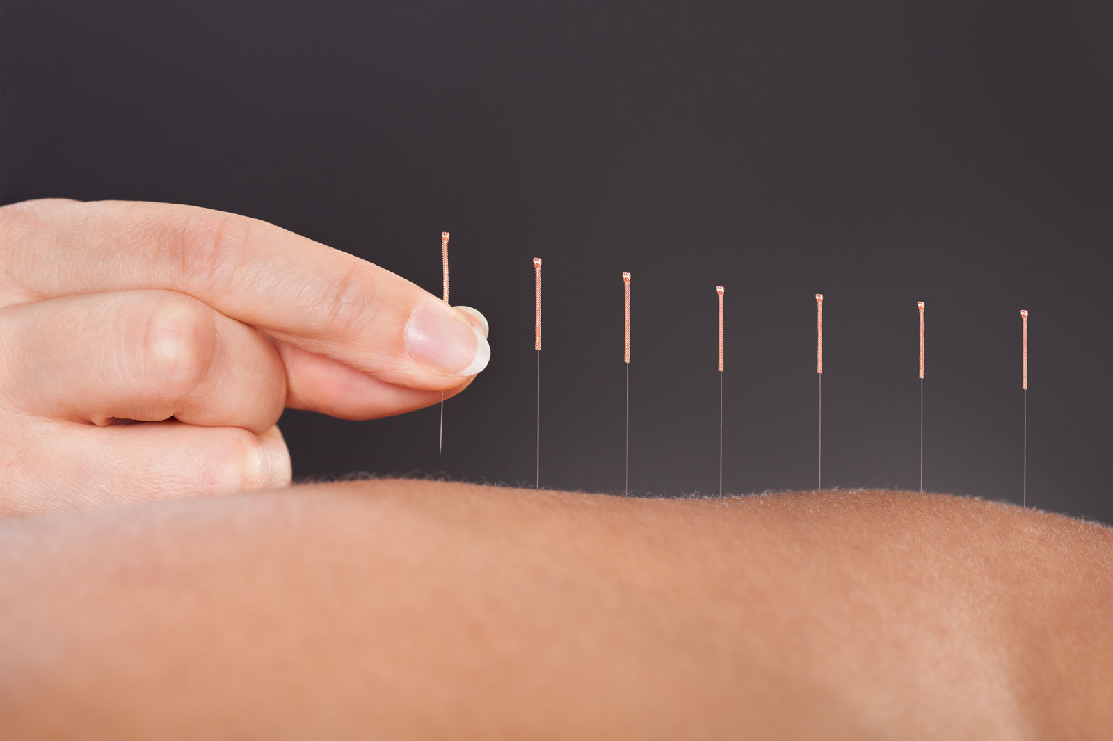 Hand-placing-acupuncture-needles-in-exposed-back