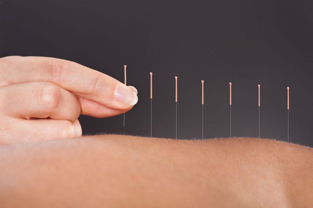 Hand placing acupuncture needles in exposed back