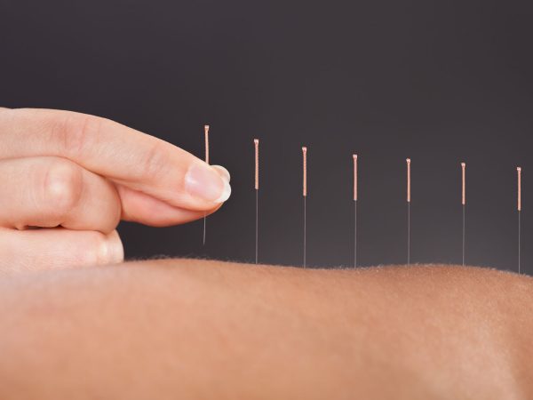 Hand placing acupuncture needles in exposed back